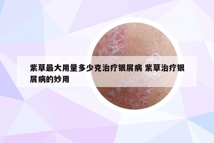 紫草最大用量多少克治疗银屑病 紫草治疗银屑病的妙用