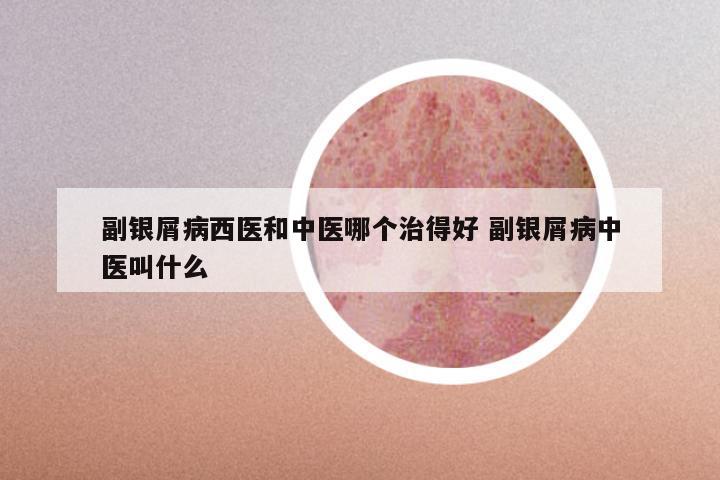 副银屑病西医和中医哪个治得好 副银屑病中医叫什么