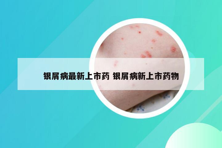 银屑病最新上市药 银屑病新上市药物