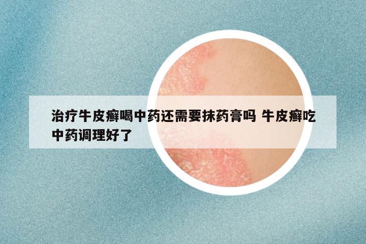 治疗牛皮癣喝中药还需要抹药膏吗 牛皮癣吃中药调理好了