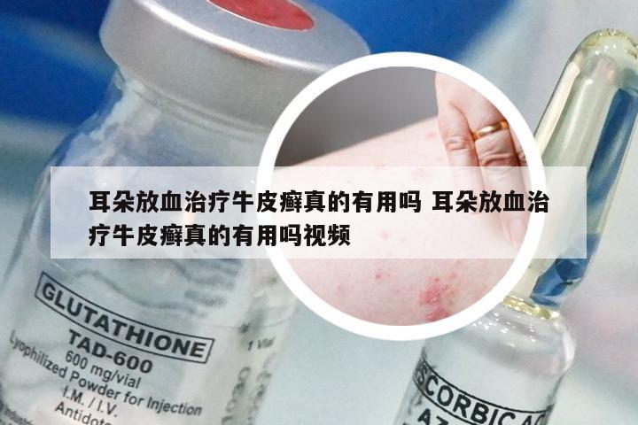 耳朵放血治疗牛皮癣真的有用吗 耳朵放血治疗牛皮癣真的有用吗视频