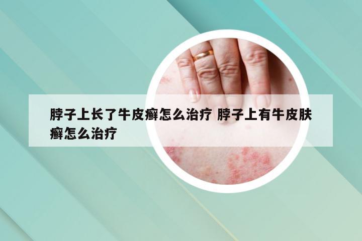 脖子上长了牛皮癣怎么治疗 脖子上有牛皮肤癣怎么治疗
