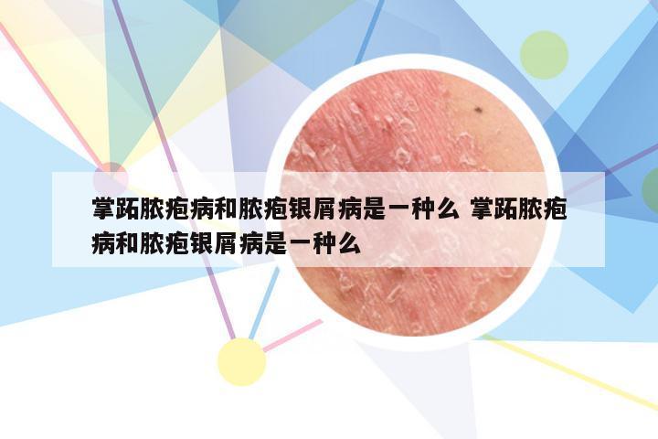 掌跖脓疱病和脓疱银屑病是一种么 掌跖脓疱病和脓疱银屑病是一种么
