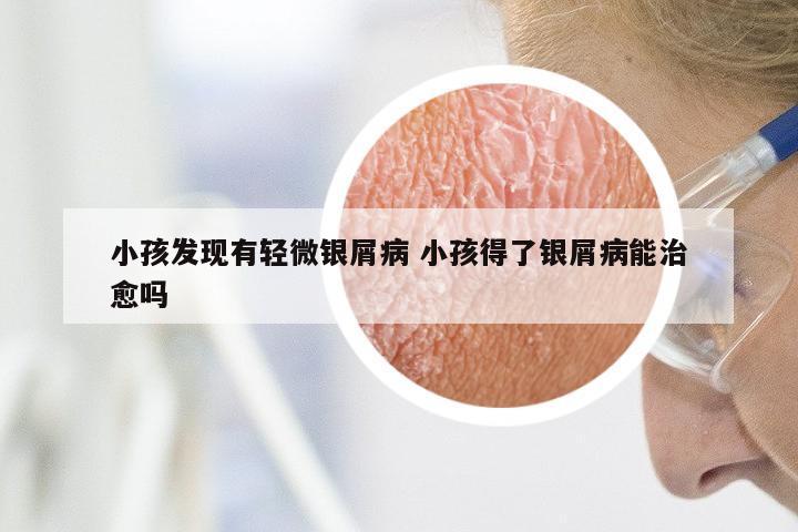 小孩发现有轻微银屑病 小孩得了银屑病能治愈吗