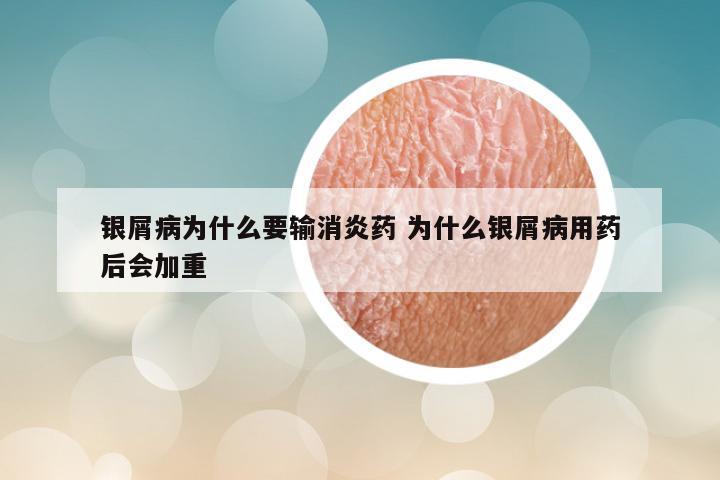 银屑病为什么要输消炎药 为什么银屑病用药后会加重