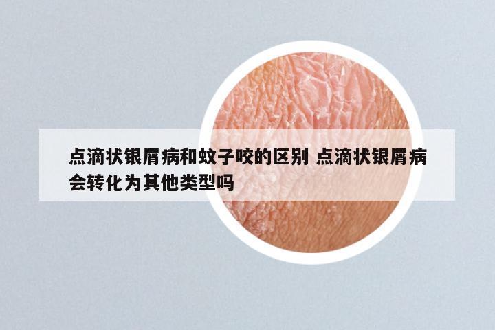 点滴状银屑病和蚊子咬的区别 点滴状银屑病会转化为其他类型吗