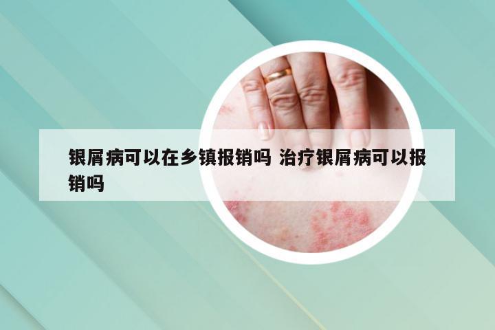 银屑病可以在乡镇报销吗 治疗银屑病可以报销吗