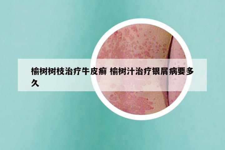 榆树树枝治疗牛皮癣 榆树汁治疗银屑病要多久
