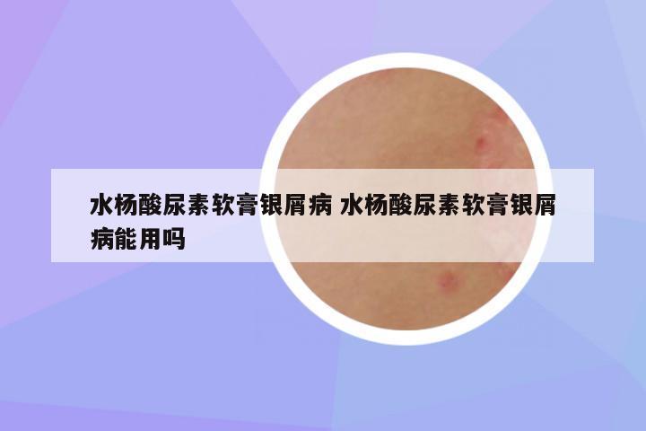 水杨酸尿素软膏银屑病 水杨酸尿素软膏银屑病能用吗