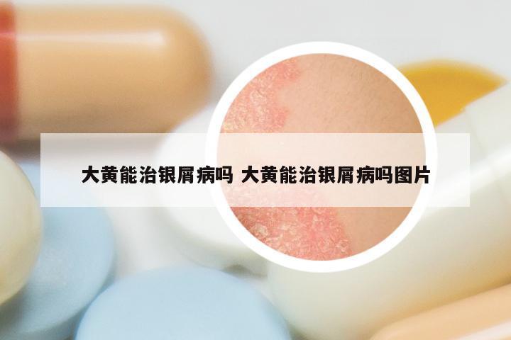 大黄能治银屑病吗 大黄能治银屑病吗图片