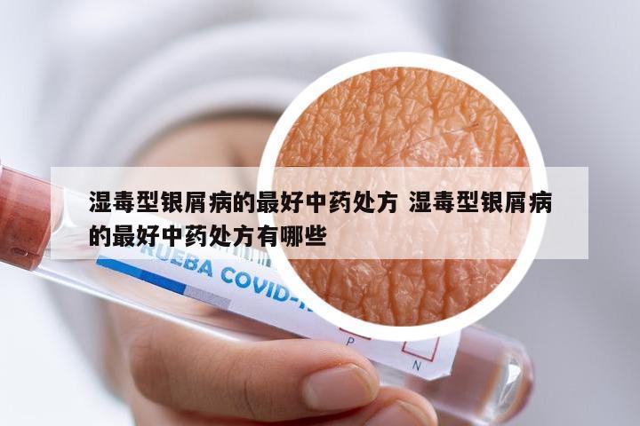 湿毒型银屑病的最好中药处方 湿毒型银屑病的最好中药处方有哪些