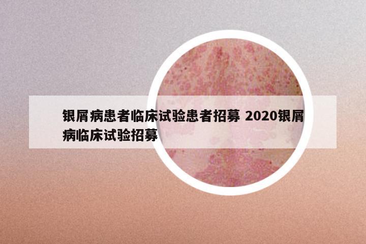 银屑病患者临床试验患者招募 2020银屑病临床试验招募