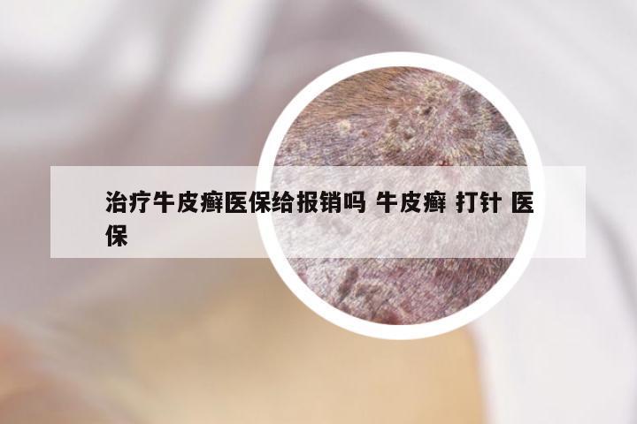 治疗牛皮癣医保给报销吗 牛皮癣 打针 医保