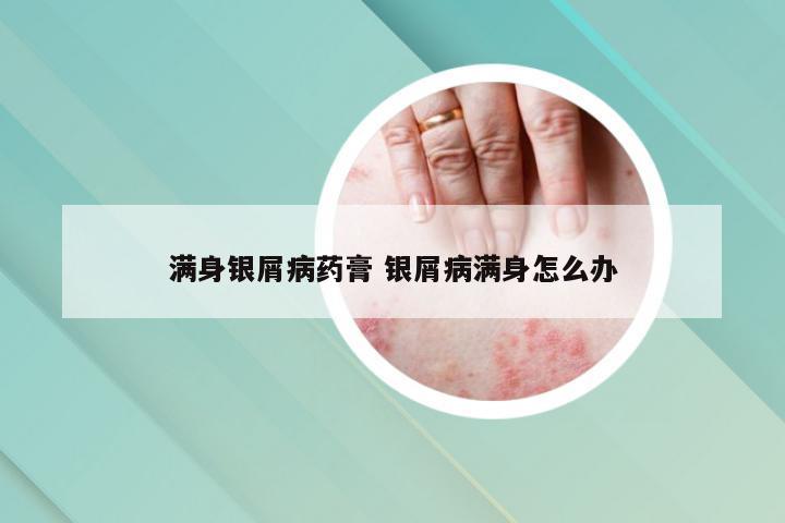 满身银屑病药膏 银屑病满身怎么办