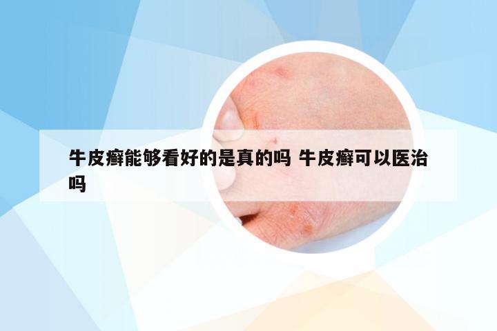 牛皮癣能够看好的是真的吗 牛皮癣可以医治吗