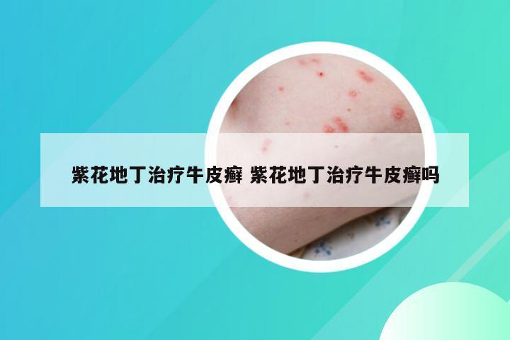 紫花地丁治疗牛皮癣 紫花地丁治疗牛皮癣吗