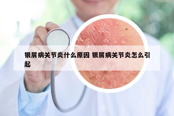 银屑病关节炎什么原因 银屑病关节炎怎么引起