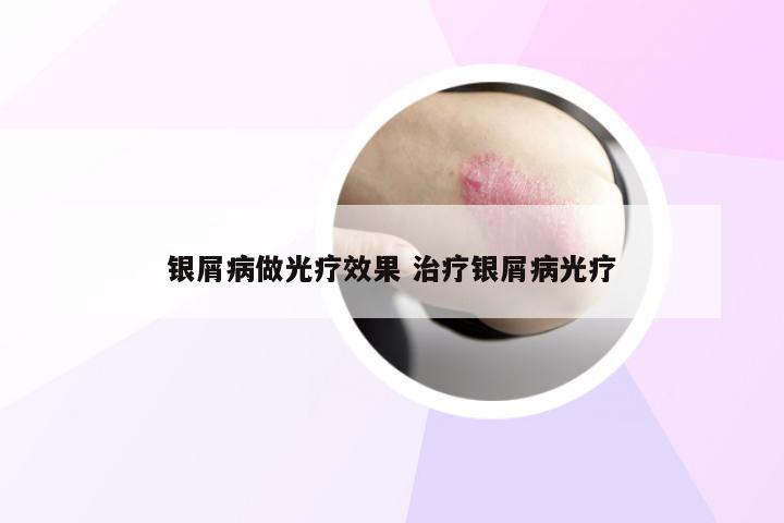银屑病做光疗效果 治疗银屑病光疗