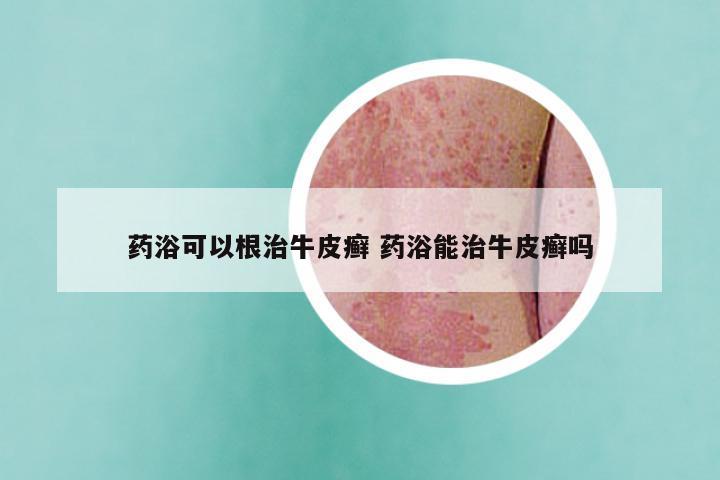 药浴可以根治牛皮癣 药浴能治牛皮癣吗
