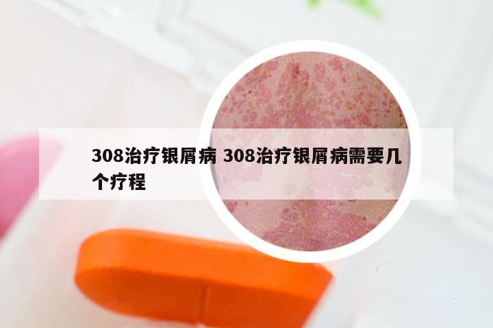 308治疗银屑病 308治疗银屑病需要几个疗程