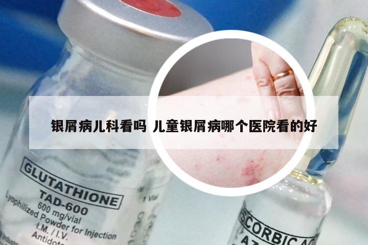 银屑病儿科看吗 儿童银屑病哪个医院看的好