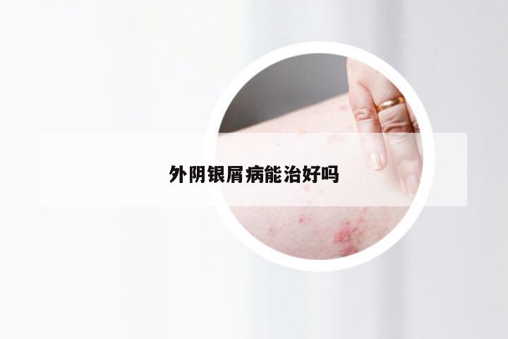 外阴银屑病能治好吗