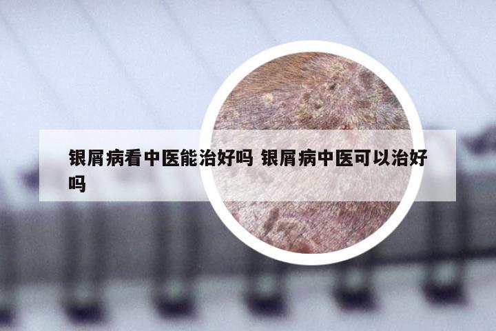 银屑病看中医能治好吗 银屑病中医可以治好吗
