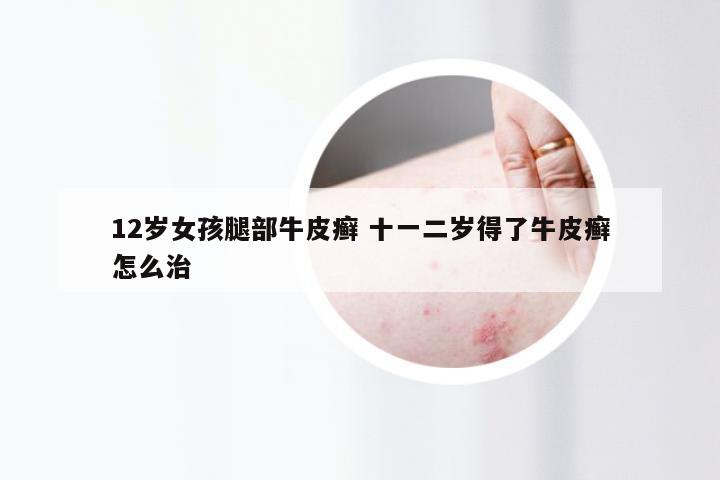 12岁女孩腿部牛皮癣 十一二岁得了牛皮癣怎么治