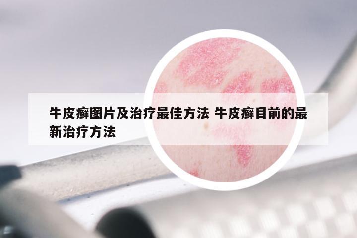 牛皮癣图片及治疗最佳方法 牛皮癣目前的最新治疗方法