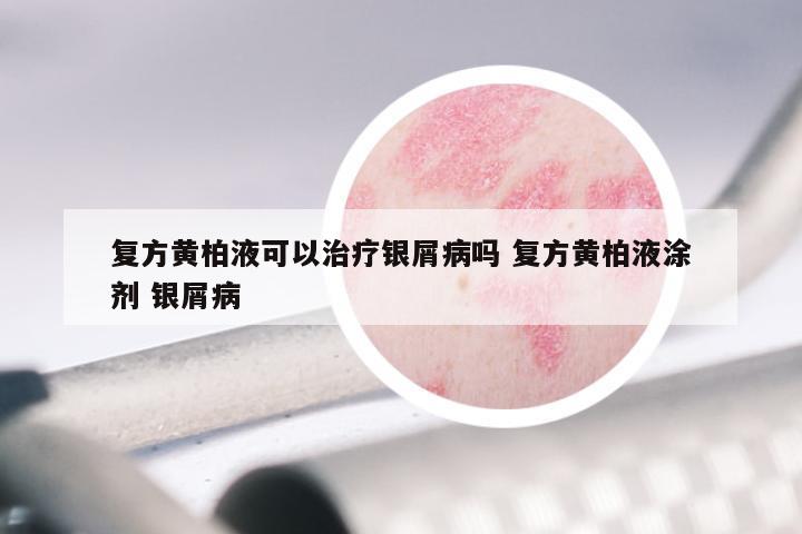 复方黄柏液可以治疗银屑病吗 复方黄柏液涂剂 银屑病