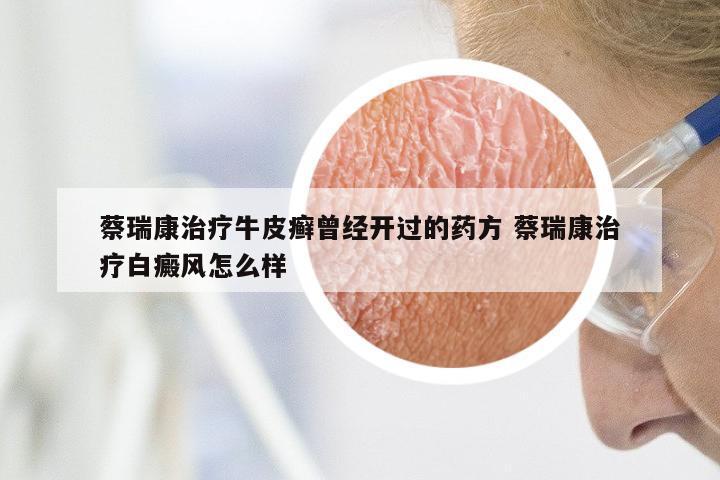 蔡瑞康治疗牛皮癣曾经开过的药方 蔡瑞康治疗白癜风怎么样