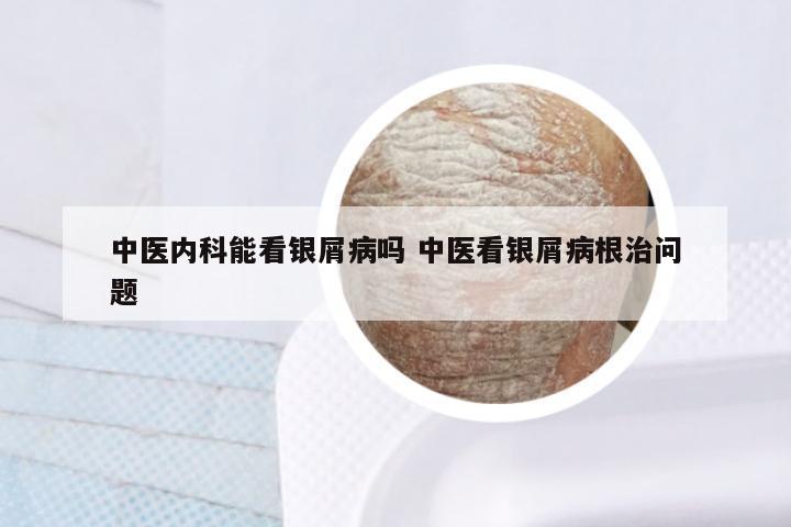 中医内科能看银屑病吗 中医看银屑病根治问题
