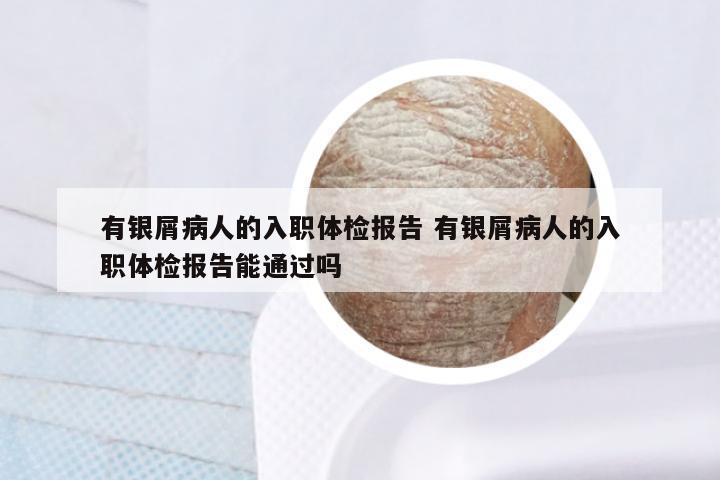 有银屑病人的入职体检报告 有银屑病人的入职体检报告能通过吗