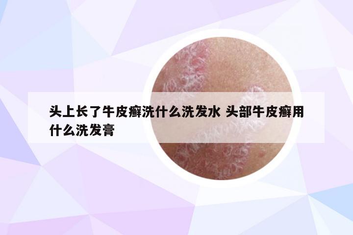 头上长了牛皮癣洗什么洗发水 头部牛皮癣用什么洗发膏