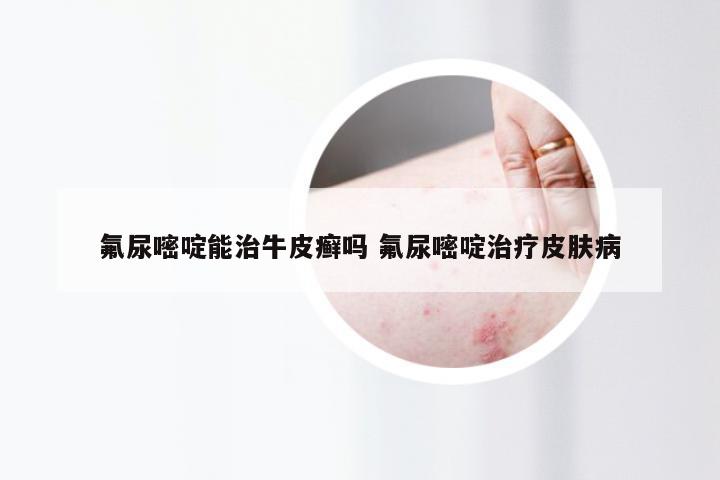 氟尿嘧啶能治牛皮癣吗 氟尿嘧啶治疗皮肤病