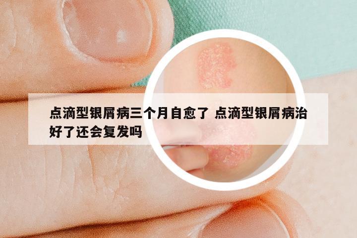 点滴型银屑病三个月自愈了 点滴型银屑病治好了还会复发吗