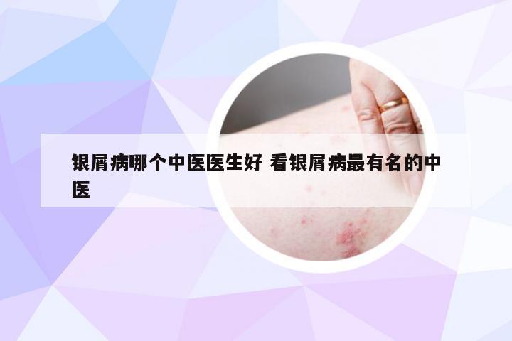 银屑病哪个中医医生好 看银屑病最有名的中医