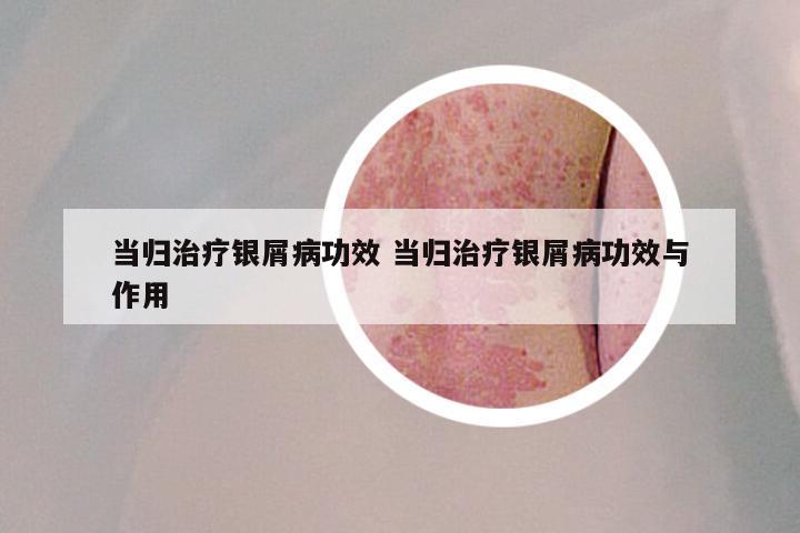 当归治疗银屑病功效 当归治疗银屑病功效与作用