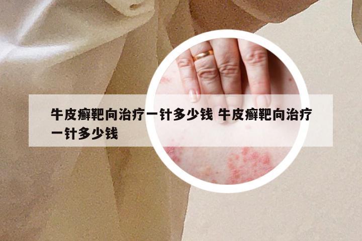 牛皮癣靶向治疗一针多少钱 牛皮癣靶向治疗一针多少钱