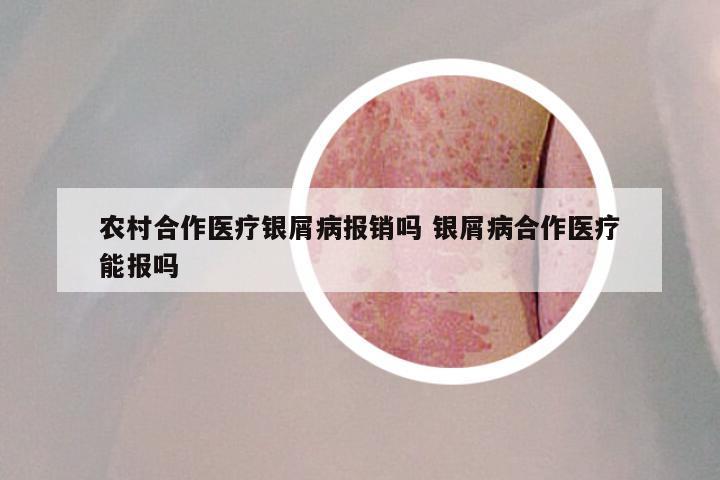 农村合作医疗银屑病报销吗 银屑病合作医疗能报吗