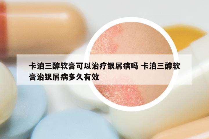 卡泊三醇软膏可以治疗银屑病吗 卡泊三醇软膏治银屑病多久有效