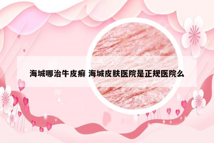 海城哪治牛皮癣 海城皮肤医院是正规医院么