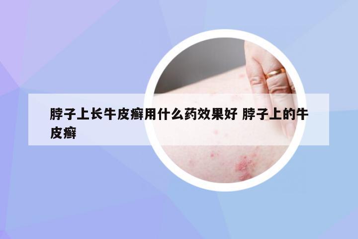 脖子上长牛皮癣用什么药效果好 脖子上的牛皮癣