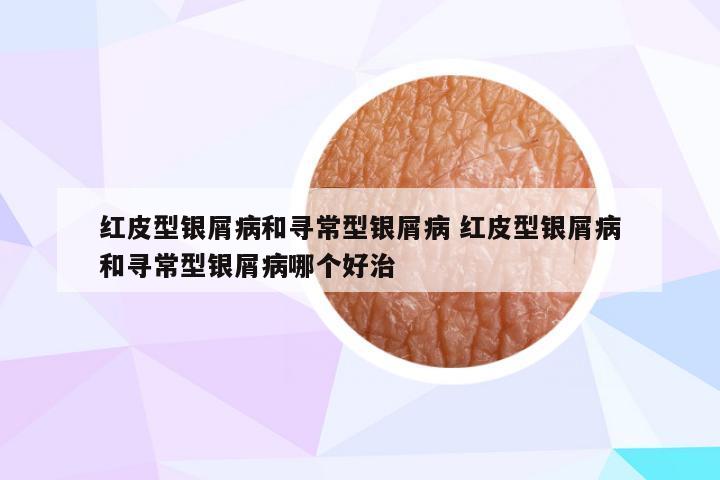 红皮型银屑病和寻常型银屑病 红皮型银屑病和寻常型银屑病哪个好治