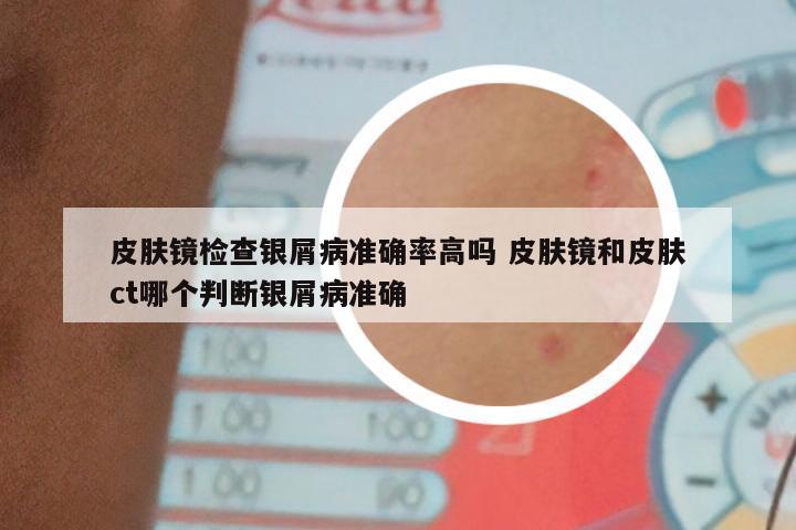 皮肤镜检查银屑病准确率高吗 皮肤镜和皮肤ct哪个判断银屑病准确