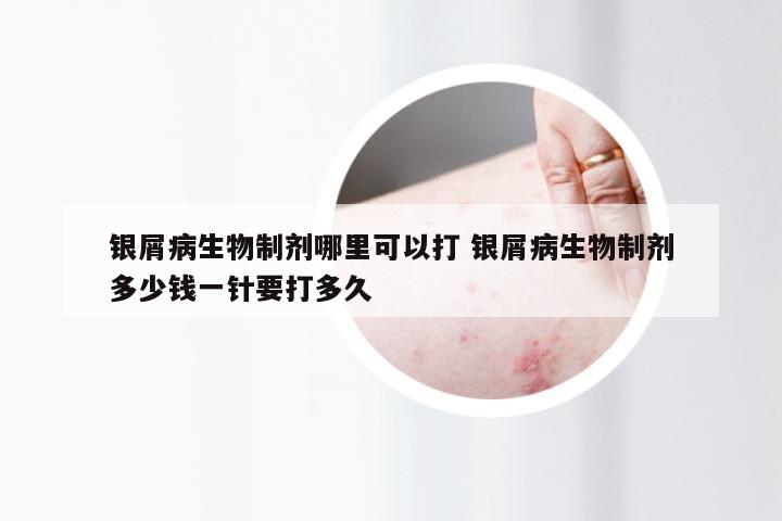 银屑病生物制剂哪里可以打 银屑病生物制剂多少钱一针要打多久