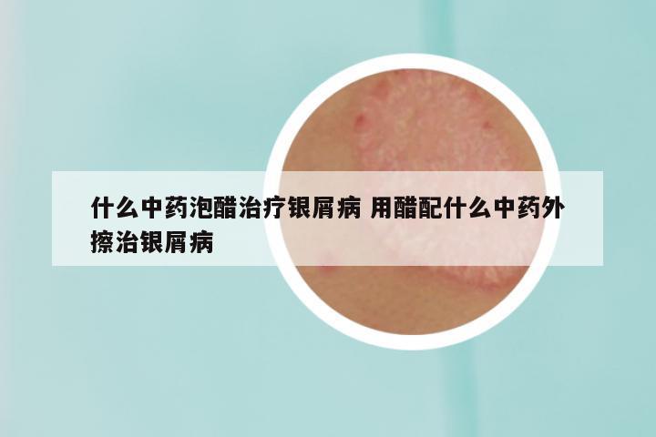 什么中药泡醋治疗银屑病 用醋配什么中药外擦治银屑病