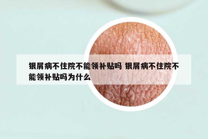 银屑病不住院不能领补贴吗 银屑病不住院不能领补贴吗为什么