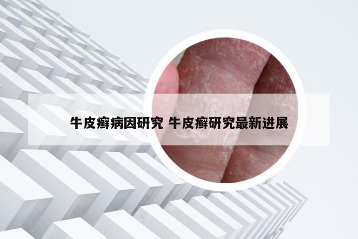 牛皮癣病因研究 牛皮癣研究最新进展
