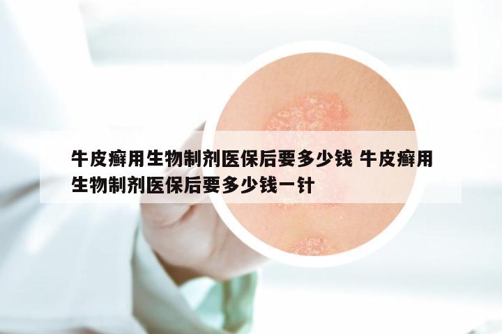 牛皮癣用生物制剂医保后要多少钱 牛皮癣用生物制剂医保后要多少钱一针